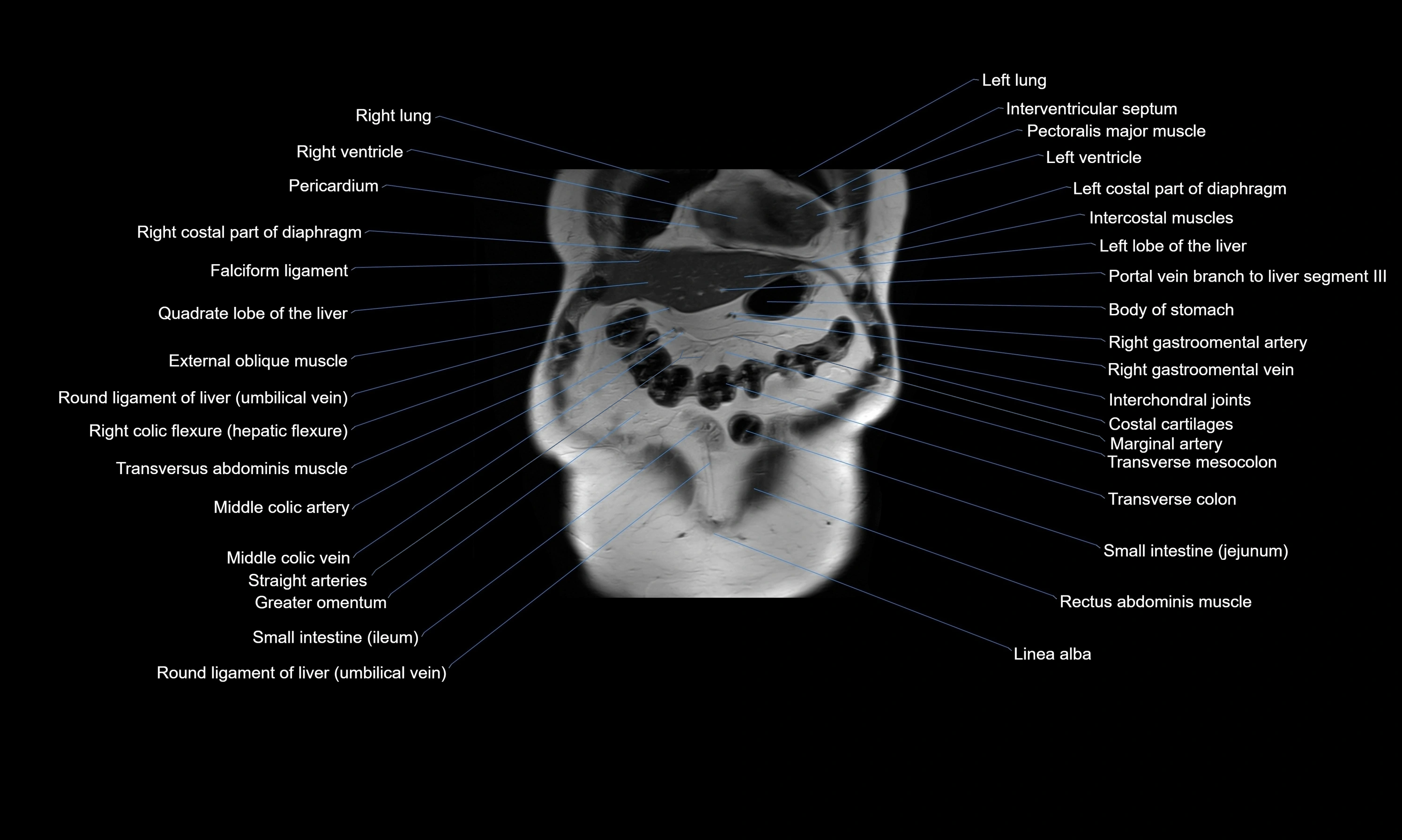 MRI Abdomen axial cross sectional anatomy radiology  image-img-00001-00012.webp
